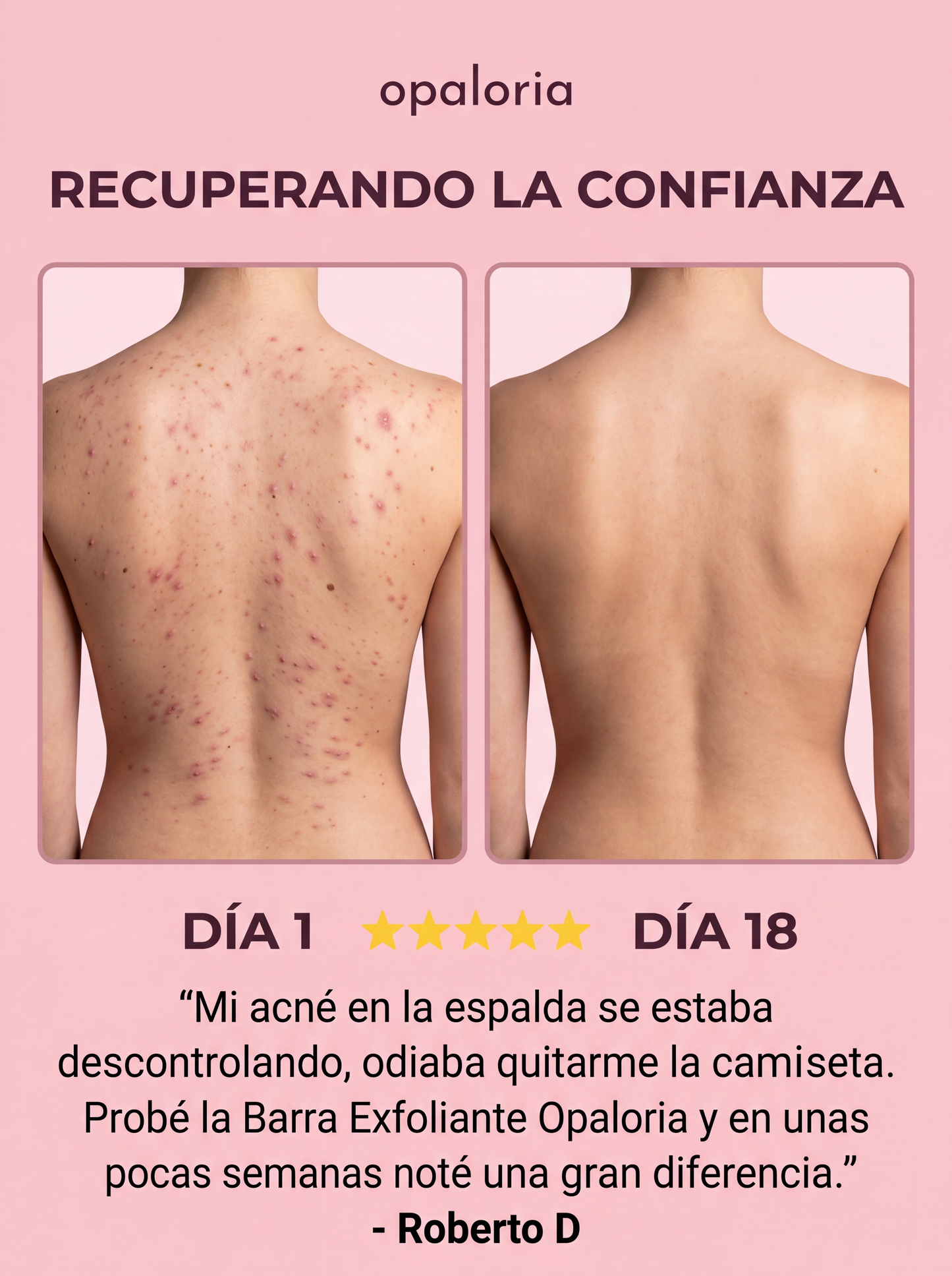 Barra Anti Granos y Manchas – Espalda libre